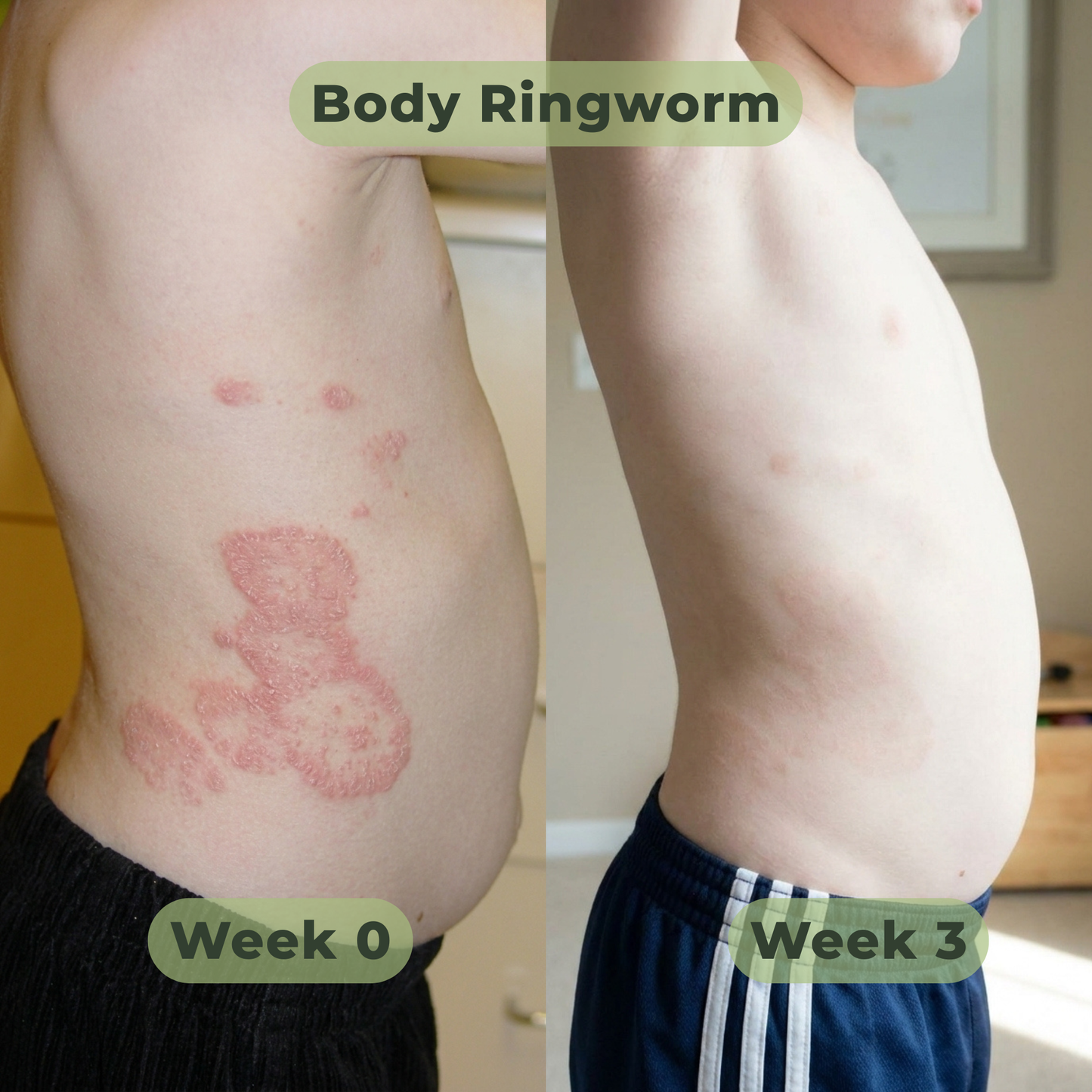 Tea Tree Antifungal Bar – Clears Fungal Infection and Skin Balance from the Root