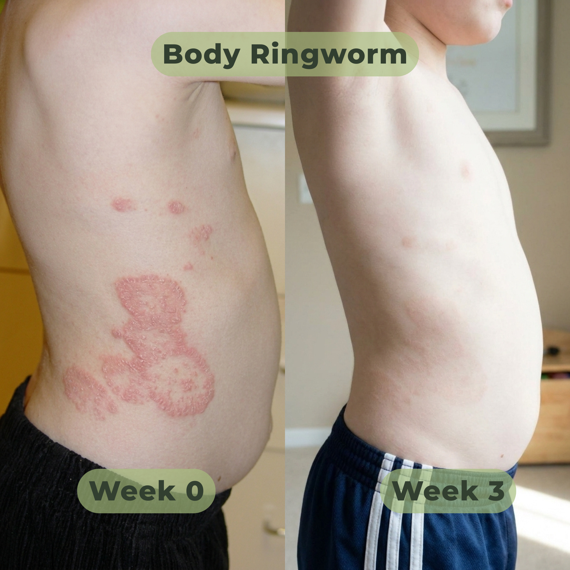 Tea Tree Antifungal Bar – Clears Fungal Infection and Skin Balance from the Root