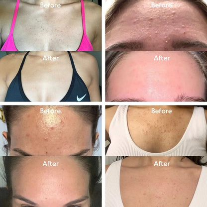 Mandelic Acid Level 2 Body Serum – Extra Strength Acne & Spot Treatment